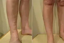 Avant / après — traitement 1